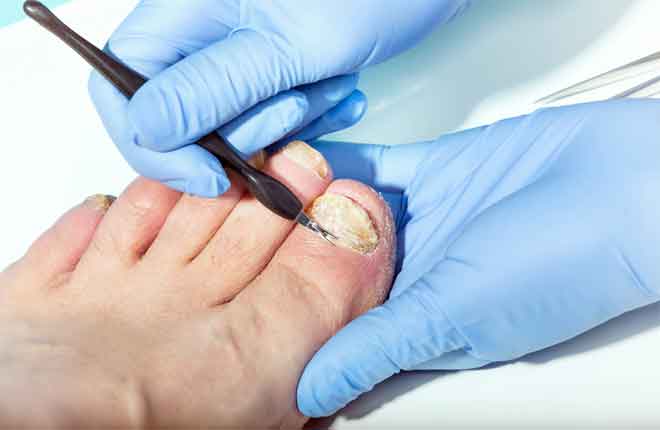 How To Get Rid Of Bad Toenail Fungus